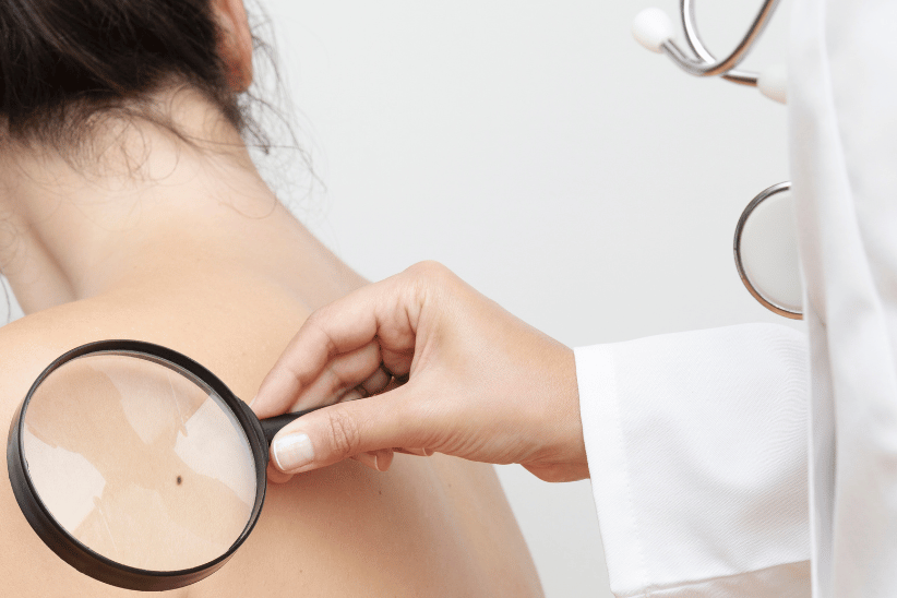 Doctor Checking Mole with Magnifier